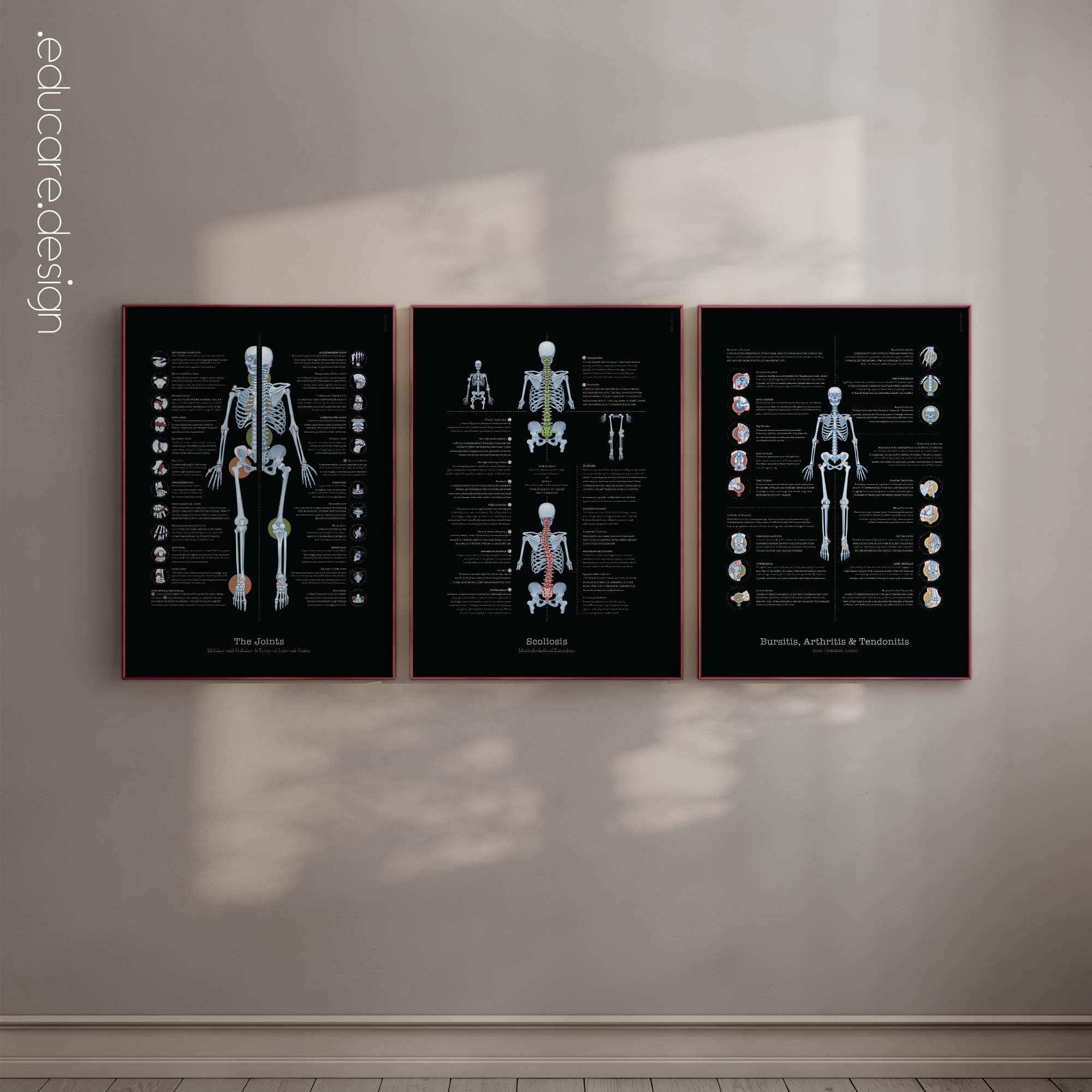 Bursitis, Arthritis and Tendonitis anatomy chart for clinics