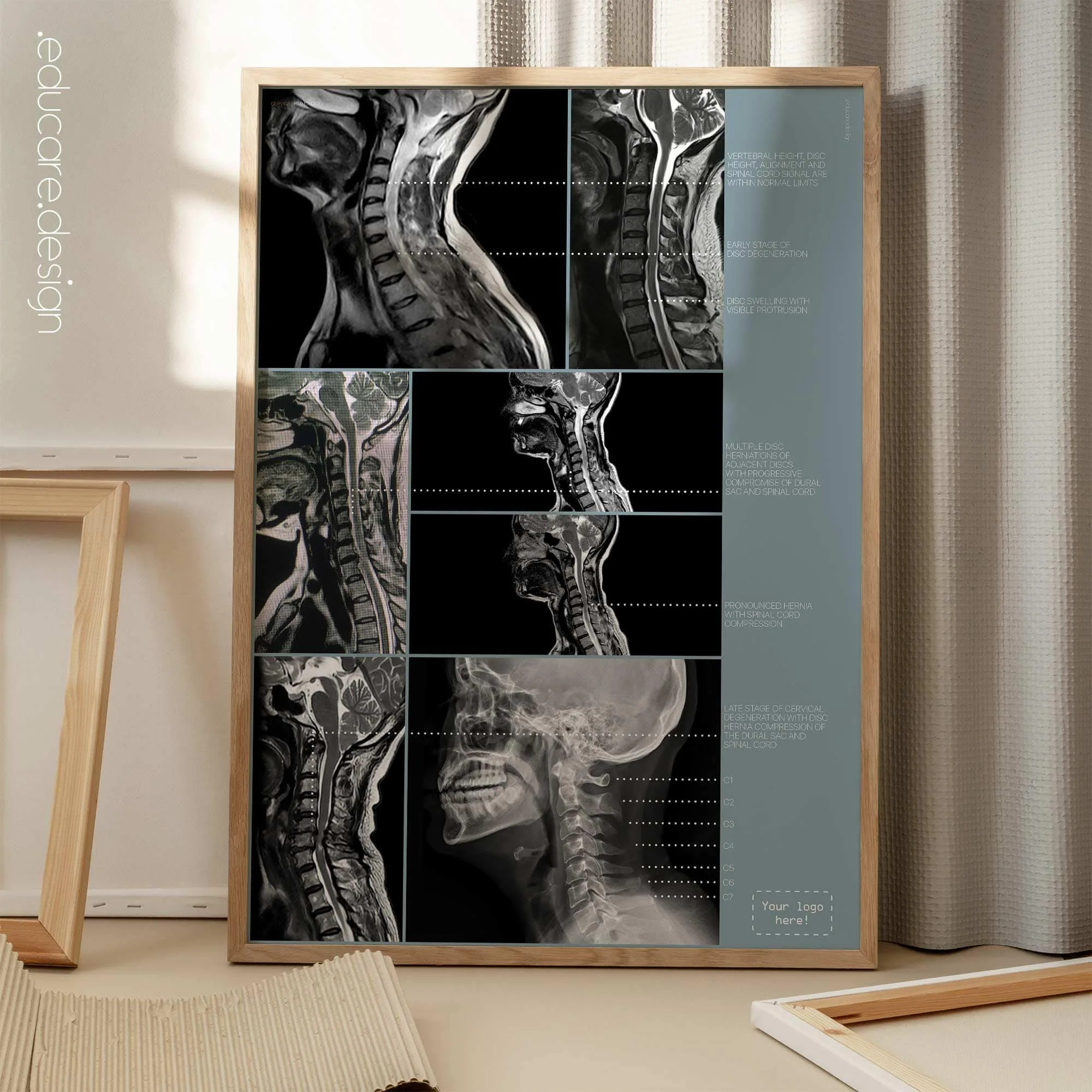 Cervical Pathology anatomy chart for clinics