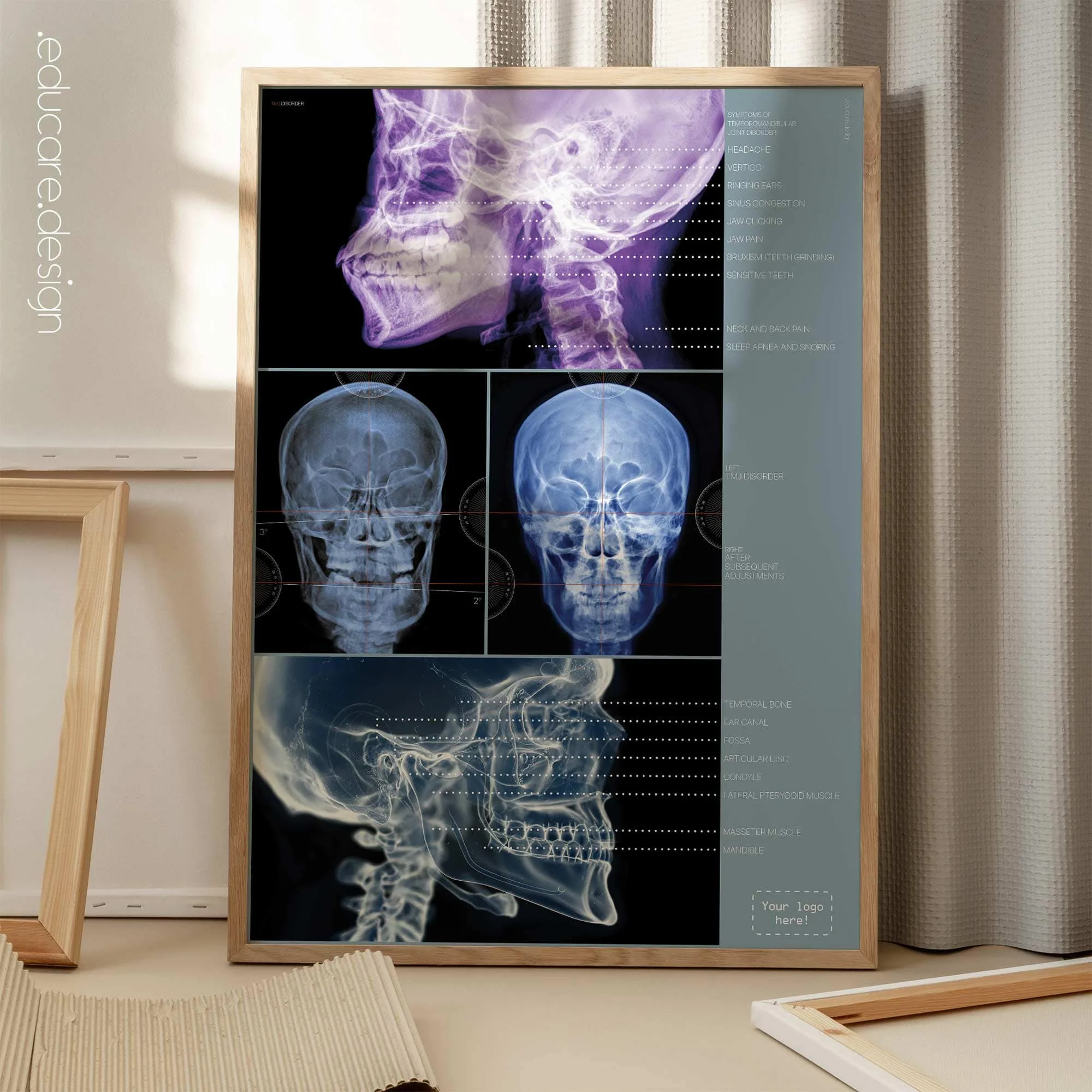TMJ Disorder anatomy chart for clinics