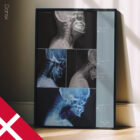 Vorwärts gerichtete Kopfhaltung