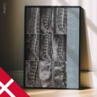 Lumbal Patologi anatomidiagram til klinikker