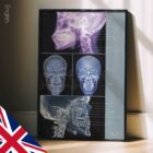 TMJ Disorder anatomy chart for clinics