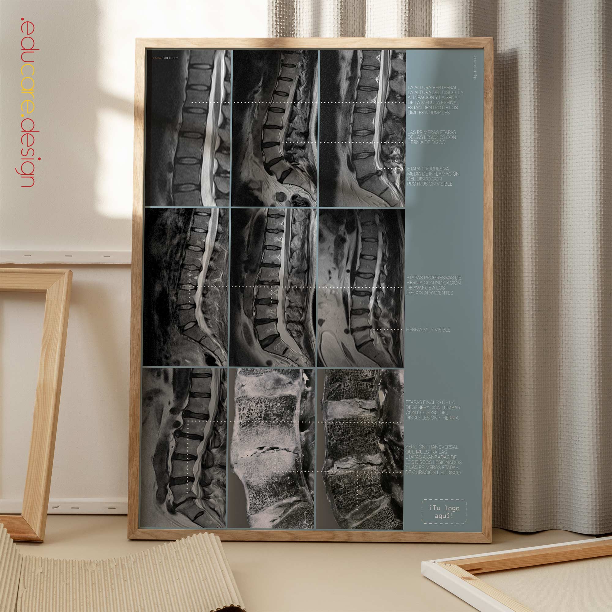 Lumbar Pathology artwork from educare.design