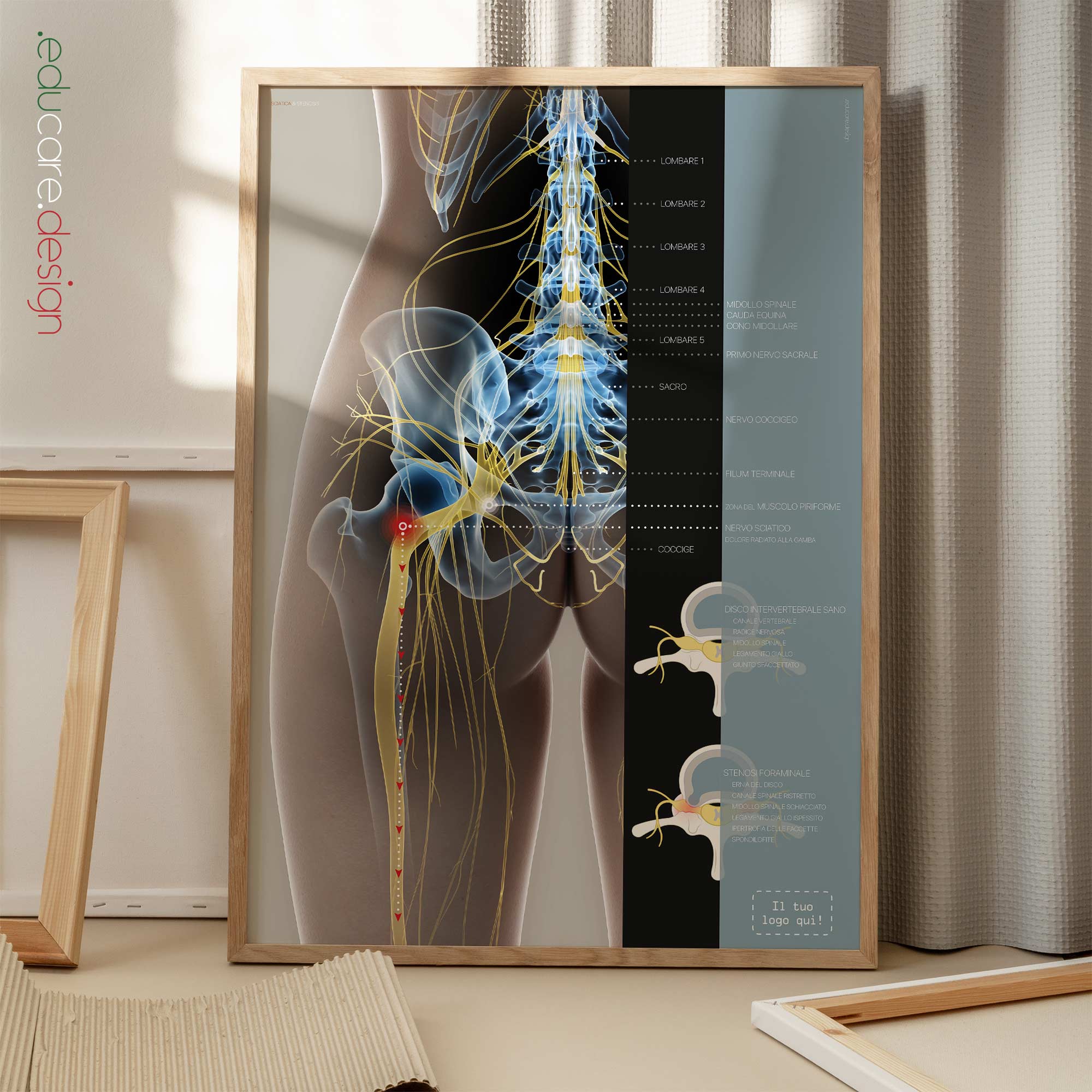 Sciatica and stenosis artwork from educare.design