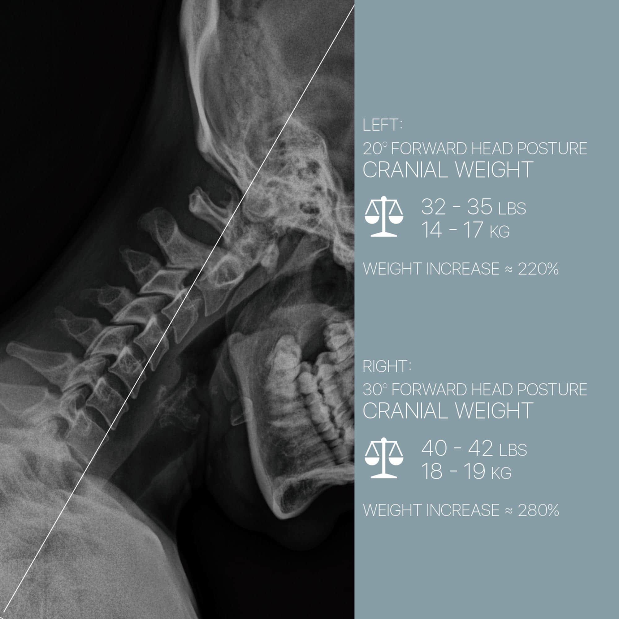 forward head posture english zoom 02