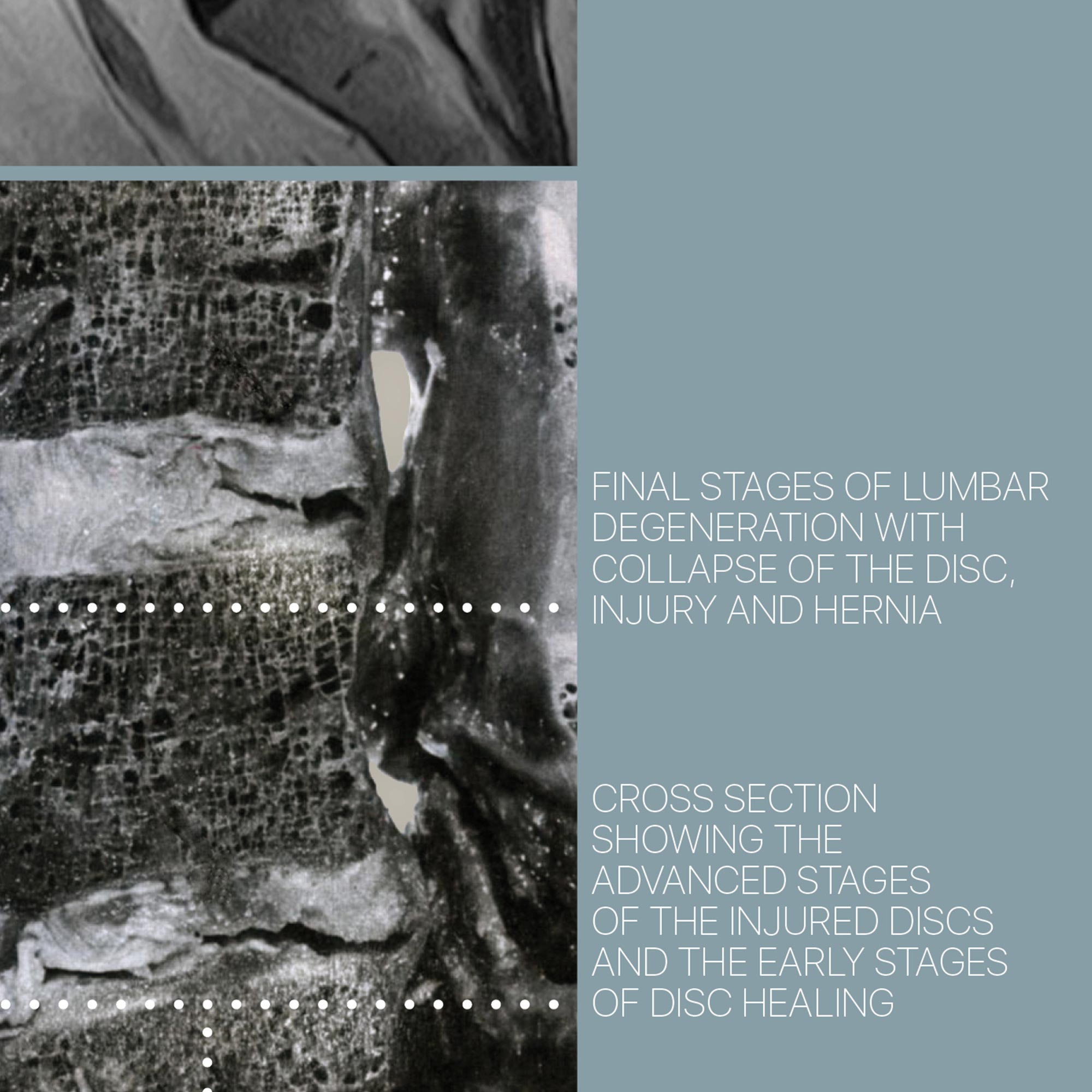lumbar pathology english zoom 02