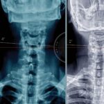 Desalineación espinal