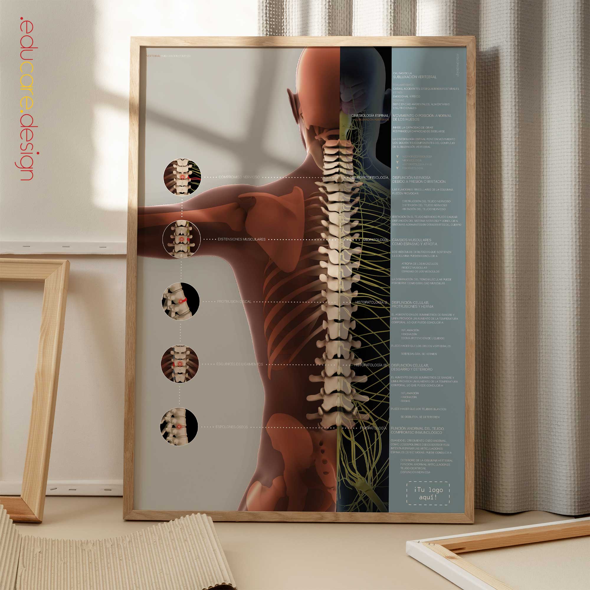 Complejo de Subluxación Vertebral