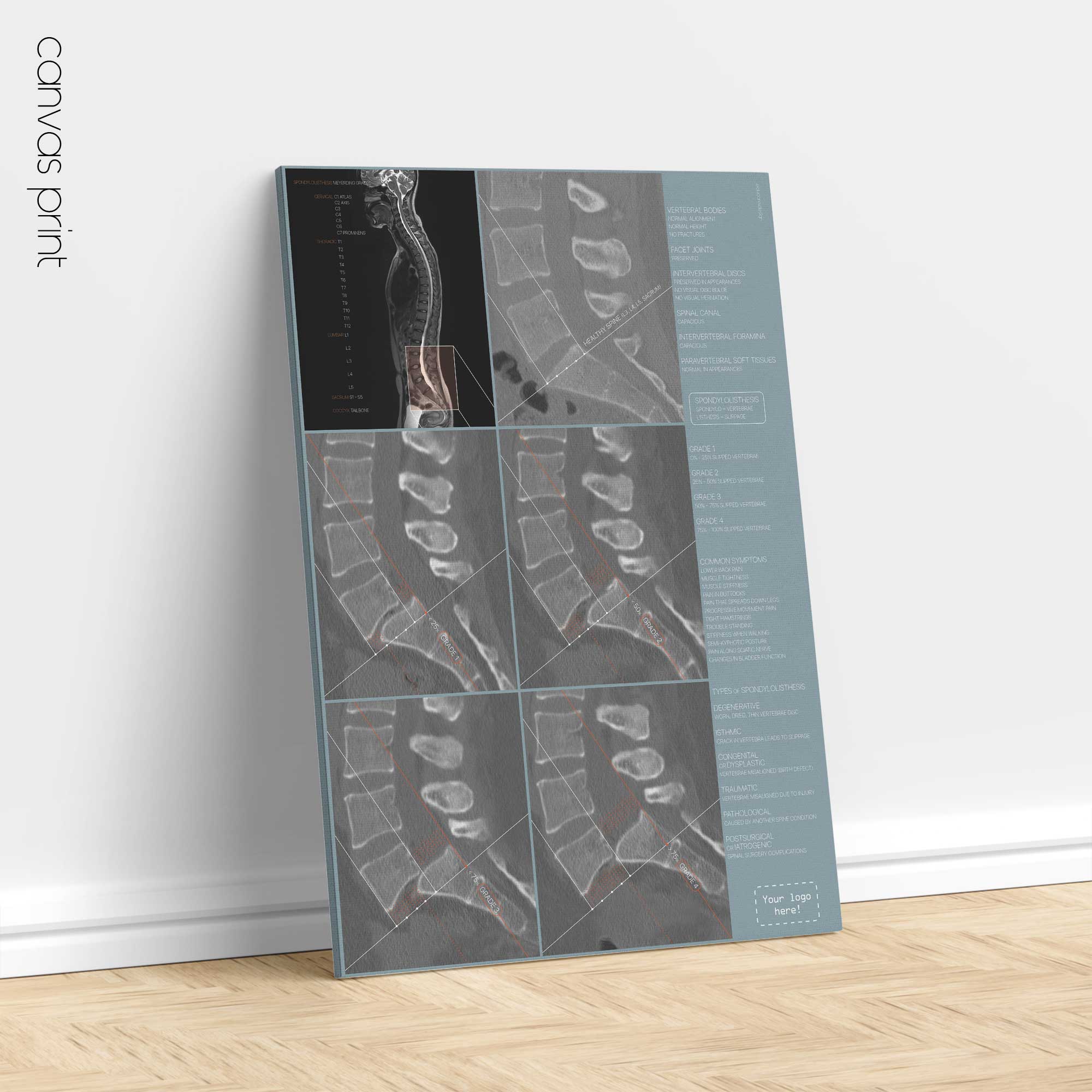 Spondylolisthesis