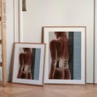Spinal Subluxation Effects anatomy chart for clinics