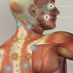 Fibromyalgie