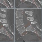 Spondilolistesi