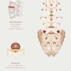 The Herniated Disc anatomy chart for clinics