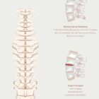 The Herniated Disc anatomy chart for clinics