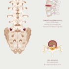 The Herniated Disc anatomy chart for clinics