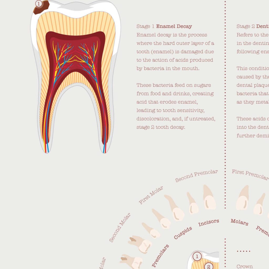 Stages of Tooth Decay » educare.design