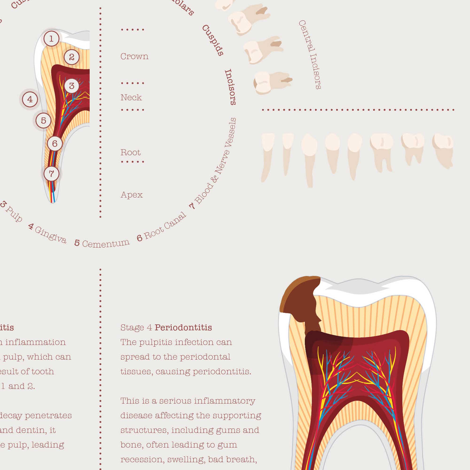 Zoomed In Tooth zoom 02 Stages of Tooth Decay