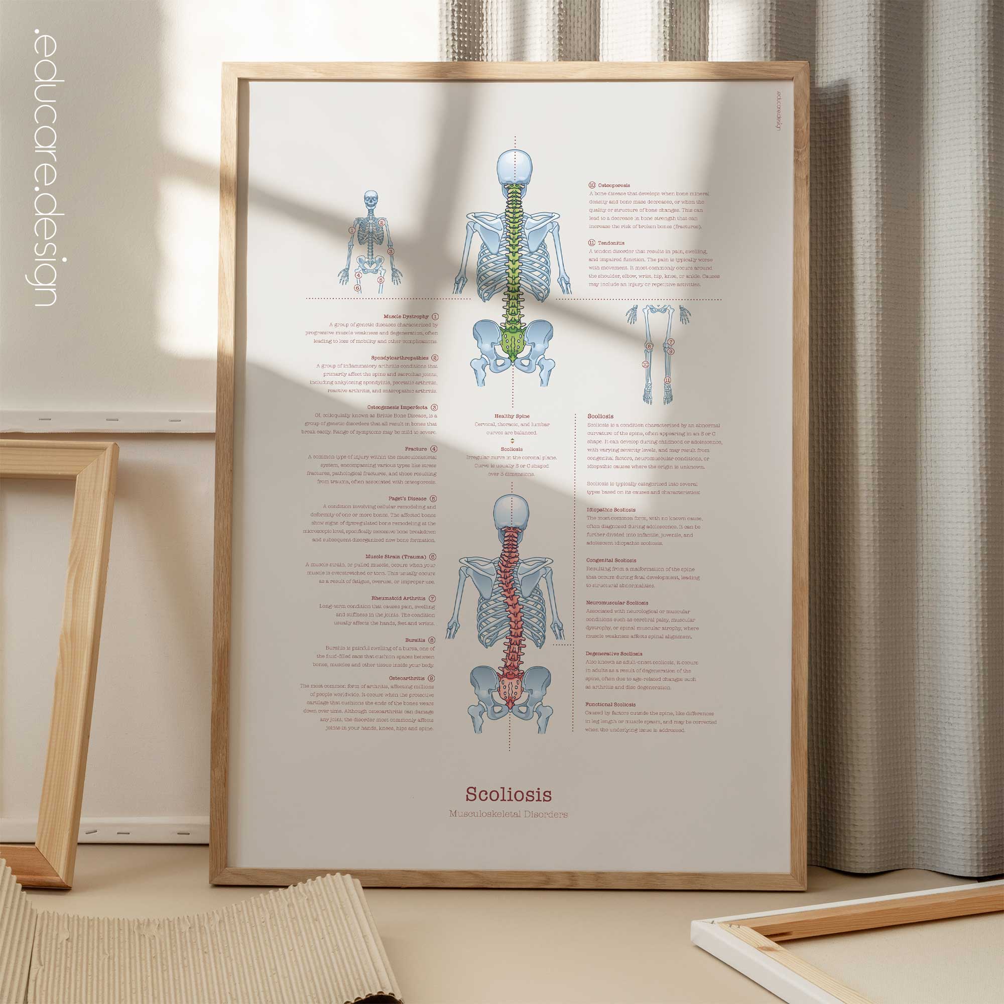 Scoliosis & Musculoskeletal Disorders