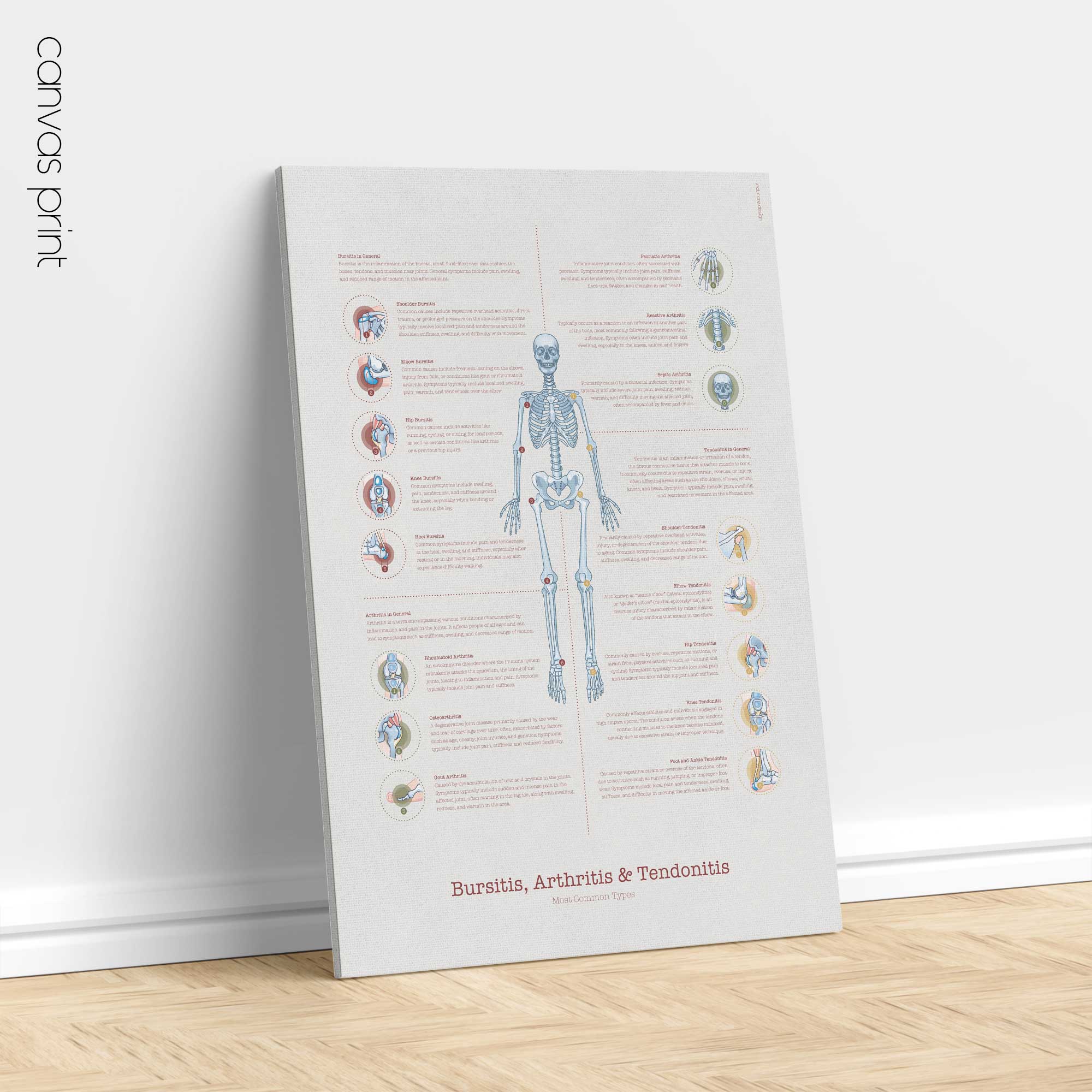 Bursitis Arthritis & Tendonitis