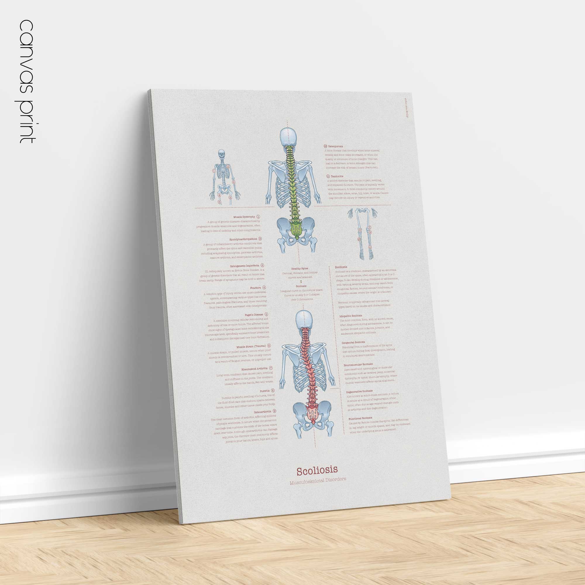 Scoliosis & Musculoskeletal Disorders