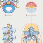 Mechanism of Sciatica anatomy chart for clinics