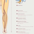 Mechanism of Sciatica anatomy chart for clinics