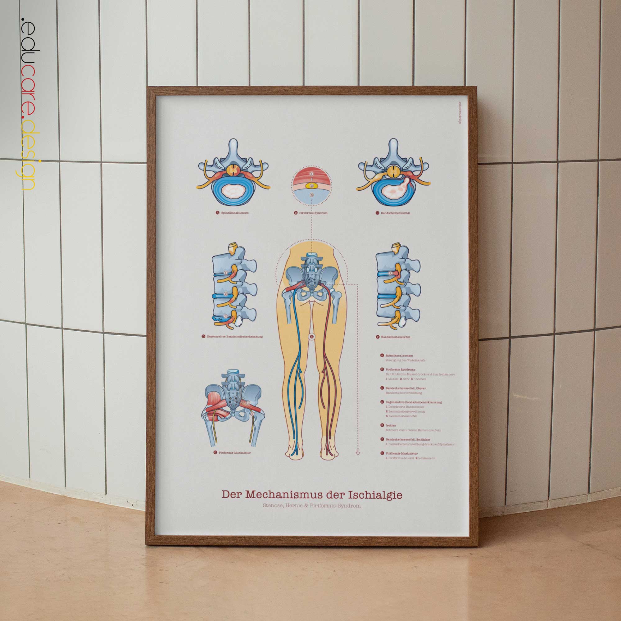 Ischias mit Stenose, Hernie und Piriformis-Syndrom.