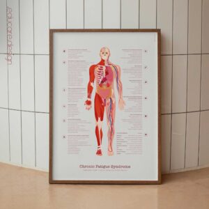 Chronic Fatigue Sindrome chart with Diagnostic Check, Common Symptoms & Risk Factors