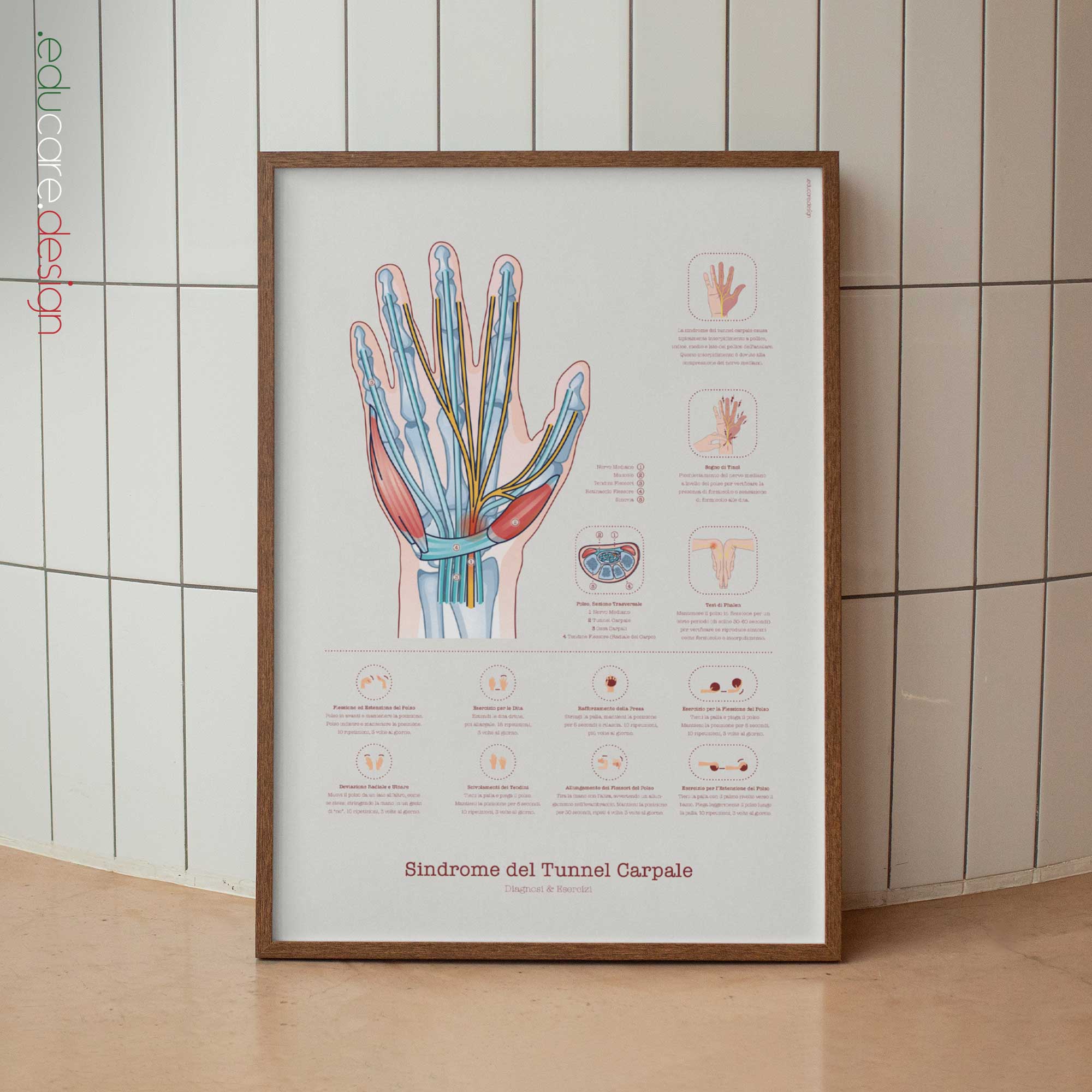 Sindrome del Tunnel Carpale con Diagnosi ed Esercizi